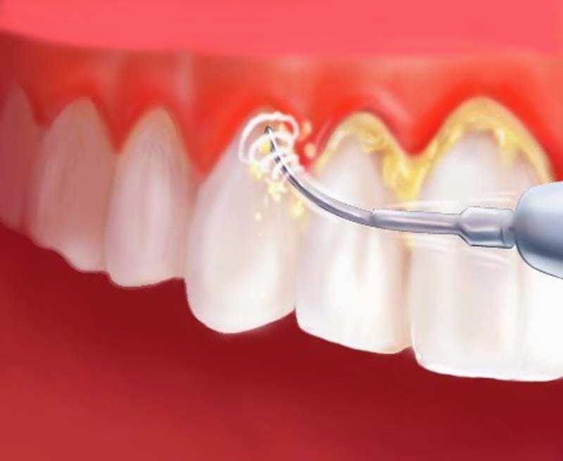 Tips Cara Memutihkan Gigi